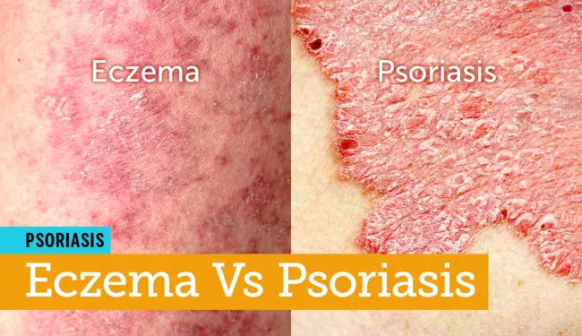 Eczema Vs Psoriasis Are They One And The Same Mypsoriasisteam