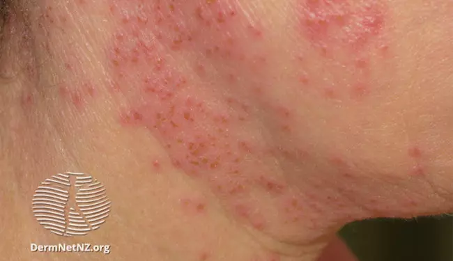 Eczema herpeticum on the neck