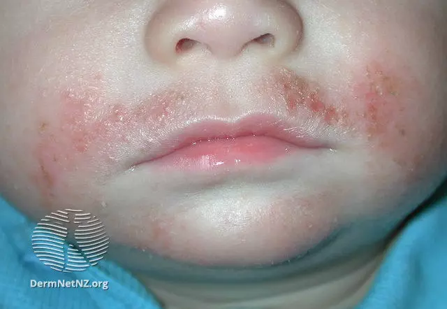 A baby with atopic dermatitis on the face