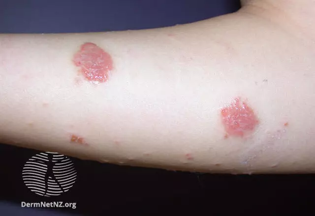 Nummular dermatitis on the arm